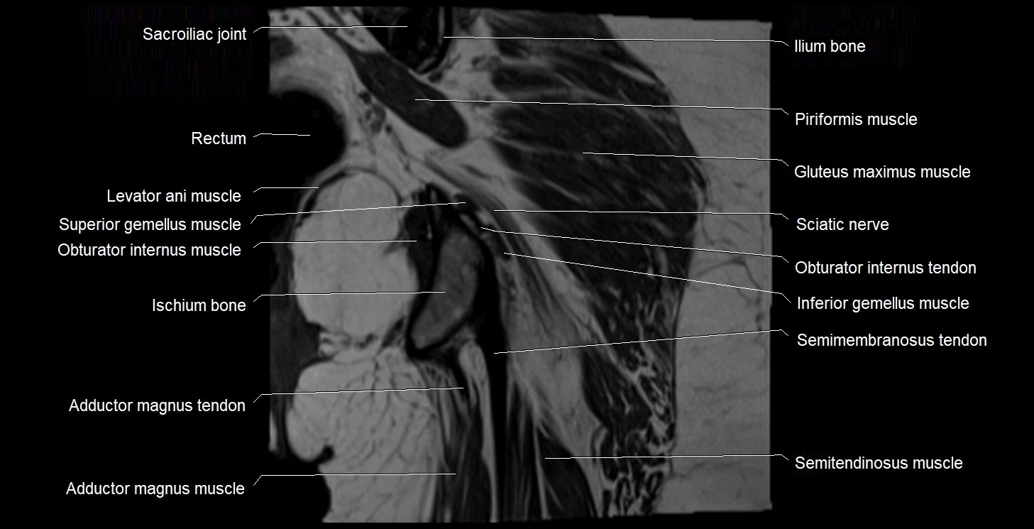 MRI Hip 3T coronal cross sectional anatomy image 51.webp